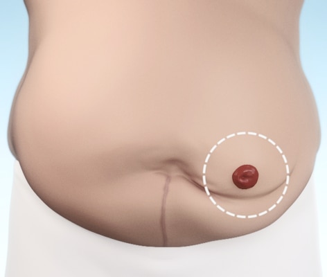 מדריכים עבור ציוד סטומה ומוצרים נלווים לסטומה