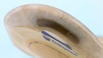 התמודדות עם אתגרים הקשורים לשקית הסטומה