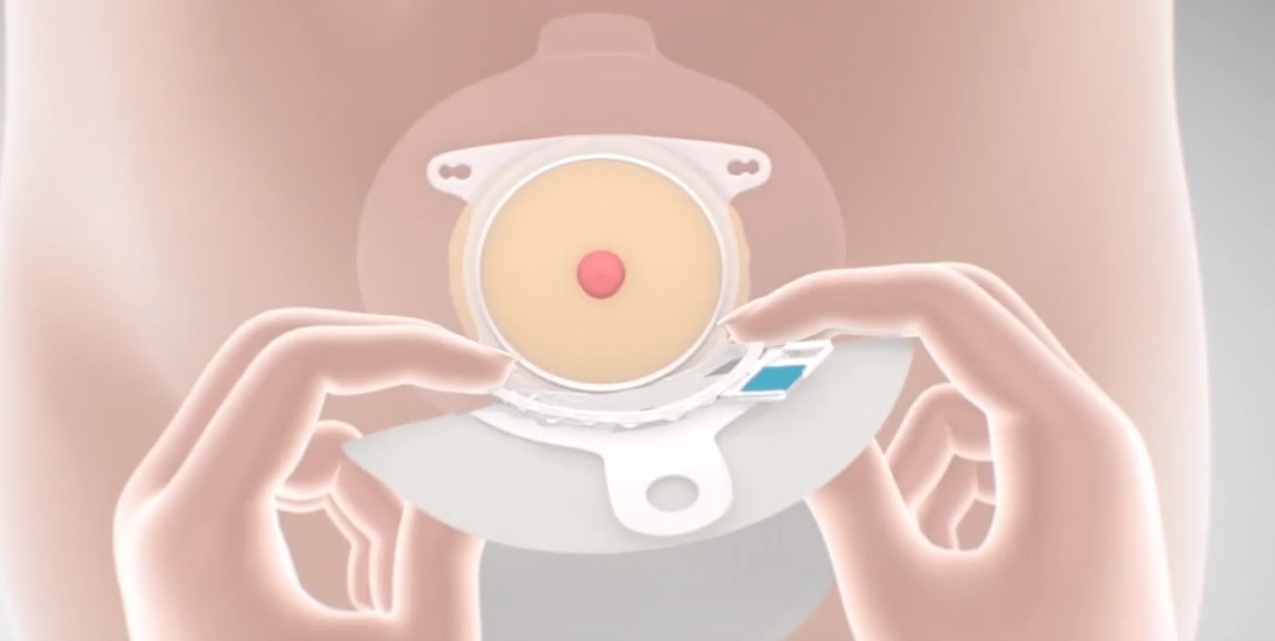 השמה וחיבור שקית סנסורה מיו 2 חלקים