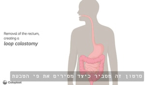 לולאת קולסטומי, הסרת רקטום