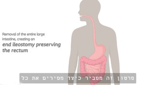 אילאוסטומי, הסרת מעי גס