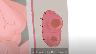 לולאת אילאוסטומי