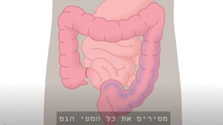 לולאת אילואסטומי ופאוץ הסרת מעי גס ורקטום